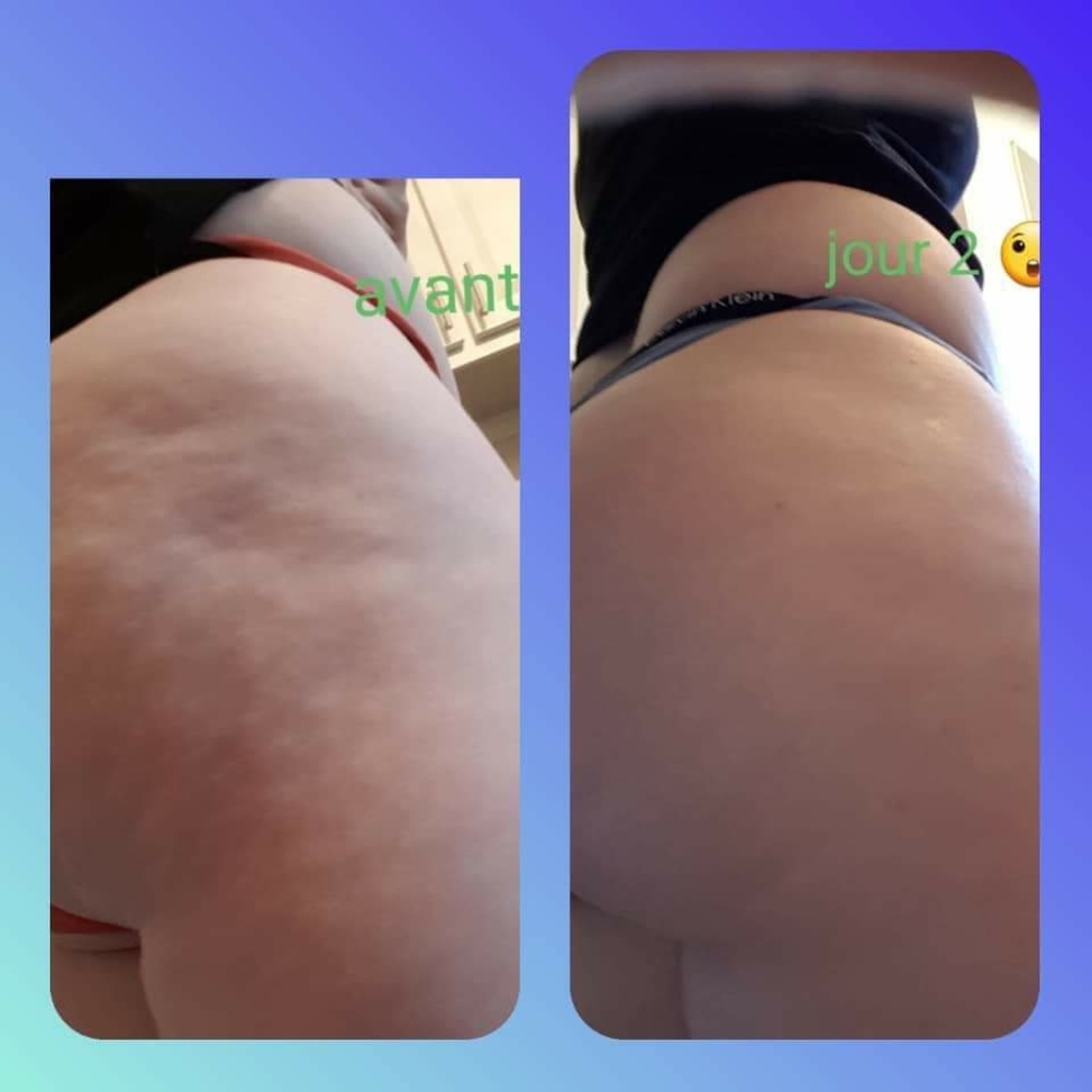 cellulite cream